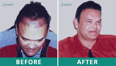 hair transplant before after 5