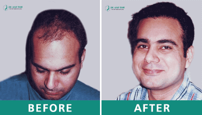 Hair Transplant in Lahore | Dr Asad Toor Hair Transplant Surgeon Pakistan