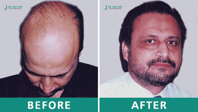 hair transplant before after 7
